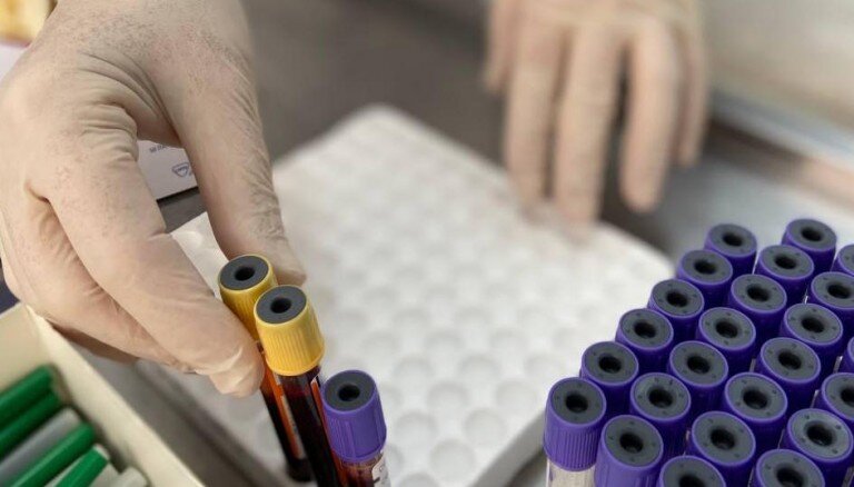 Анализ крови T-SPOT